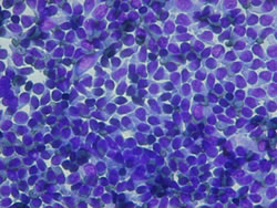 T細胞性低グレードリンパ腫