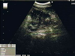 小腸が塊になって見える超音波所見