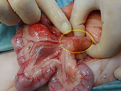 腫大した腸管のリンパ節