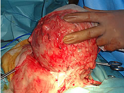 腫瘍を摘出している術中の写真