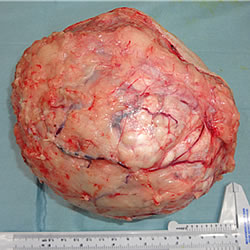 摘出した巨大な腫瘍